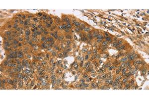 Immunohistochemistry of paraffin-embedded Human esophagus cancer using TNFSF15 Polyclonal Antibody at dilution of 1:40 (TNFSF15 antibody)