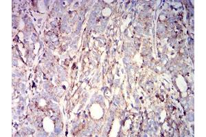 Immunohistochemical analysis of paraffin-embedded cervical cancer tissues using CD63 mouse mAb with DAB staining. (CD63 antibody  (AA 21-193))