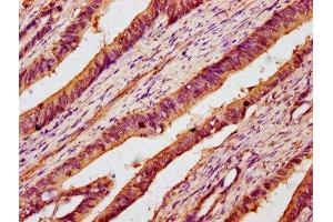 IHC image of ABIN7142974 diluted at 1:100 and staining in paraffin-embedded human colon cancer performed on a Leica BondTM system. (B3GNT6 antibody  (AA 251-345))