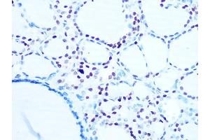 Immunohistochemistry of paraffin-embedded human thyroid cancer using Histone H1. (Histone H1 antibody)
