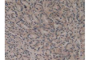 Detection of Flt3 in Human Prostate Gland Cancer Tissue using Polyclonal Antibody to FMS Like Tyrosine Kinase 3 (Flt3) (FLT3 antibody  (AA 334-543))