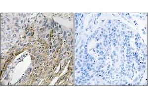 Immunohistochemistry analysis of paraffin-embedded human lung carcinoma tissue, using LONP2 Antibody. (LONP2 antibody  (AA 780-829))
