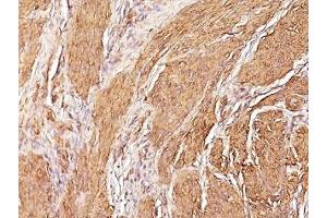 Formalin-fixed, paraffin-embedded human Leiomyosarcoma stained with Muscle Specific Actin antibody (SPM160) (Actin, Muscle Specific antibody)