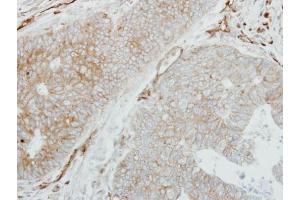 IHC-P Image Immunohistochemical analysis of paraffin-embedded human colon carcinoma, using HLA-DMB, antibody at 1:250 dilution. (HLA-DMB antibody  (C-Term))