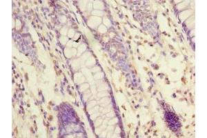 Immunohistochemistry of paraffin-embedded human colon cancer using ABIN7162093 at dilution of 1:100 (FAM55A antibody  (AA 1-405))