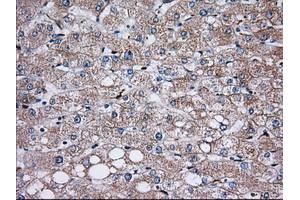 Immunohistochemical staining of paraffin-embedded Carcinoma of Human prostate tissue using anti-TBXAS1 mouse monoclonal antibody. (TBXAS1 antibody)