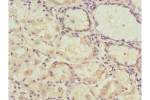 Immunohistochemistry of paraffin-embedded human gastric cancer using ABIN7166902 at dilution of 1:100 (PDHB antibody  (AA 1-300))