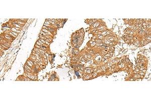 Immunohistochemistry of paraffin-embedded Human colorectal cancer tissue using GOLGA6A Polyclonal Antibody at dilution of 1:50(x200)