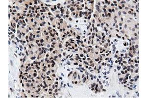 Immunohistochemical staining of paraffin-embedded Carcinoma of Human lung tissue using anti-NT5DC1 mouse monoclonal antibody.
