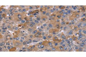 Immunohistochemistry of paraffin-embedded Human liver cancer using NCF2 Polyclonal Antibody at dilution of 1:60 (NCF2 antibody)