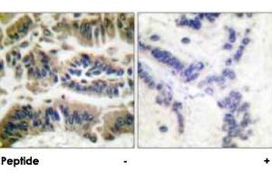 Immunohistochemical analysis of paraffin-embedded human breast carcinoma tissue using CASP6 polyclonal antibody . (Caspase 6 antibody)
