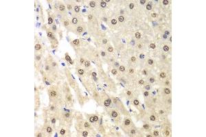 Immunohistochemistry of paraffin-embedded human liver cancer using ETS1 antibody (ABIN5970774) at dilution of 1/100 (40x lens). (ETS1 antibody)