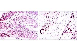 Immunohistochemical analysis of paraffin-embedded ovarian cancer (left) and lung cancer (right) using p63α mouse mAb with DAB staining. (p63alpha antibody)