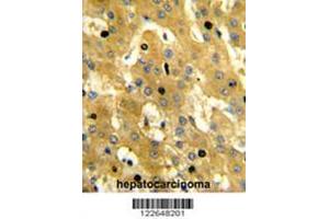 Formalin-fixed and paraffin-embedded human hepatocarcinoma reacted with SCP2 Antibody (Center), which was peroxidase-conjugated to the secondary antibody, followed by DAB staining. (SCP2 antibody  (Middle Region))
