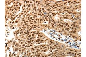 The image on the left is immunohistochemistry of paraffin-embedded Human ovarian cancer tissue using ABIN7131160(SPATA2L Antibody) at dilution 1/30, on the right is treated with fusion protein. (SPATA2L antibody)