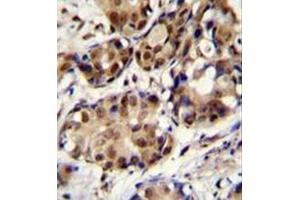 Formalin fixed and paraffin embedded human breast carcinoma stained with PELP1 Antibody (Center) followed by peroxidase conjugation of the secondary antibody and DAB staining.