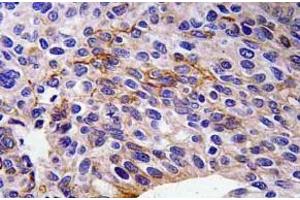Immunohistochemistry (IHC) analyzes of SEMA3A antibody in paraffin-embedded human lung carcinoma tissue. (SEMA3A antibody)