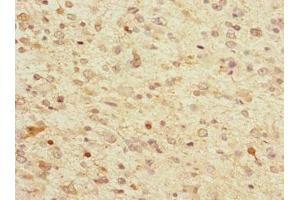 Immunohistochemistry of paraffin-embedded human glioma using ABIN7173721 at dilution of 1:100 (Tppp antibody  (AA 1-219))