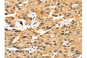 The image on the left is immunohistochemistry of paraffin-embedded Human liver cancer tissue using ABIN7131243(STX8 Antibody) at dilution 1/35, on the right is treated with fusion protein. (STX8 antibody)