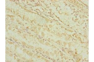 Immunohistochemistry of paraffin-embedded human gastric cancer using ABIN7164317 at dilution of 1:100 (DHTKD1 antibody  (AA 1-280))