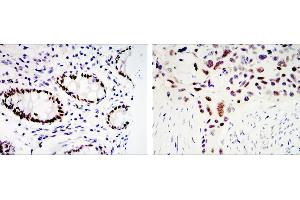 Immunohistochemical analysis of paraffin-embedded colon cancer tissues (left) and lung cancer tissues (right) using KLF4 mouse mAb with DAB staining (KLF4 antibody)