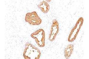 Formalin-fixed, paraffin-embedded human Prostate Carcinoma stained with PSA Mouse Monoclonal Antibody (A67-B/E3). (Prostate Specific Antigen antibody)
