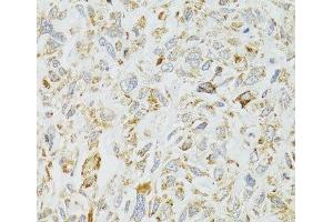Immunohistochemistry of paraffin-embedded Human lung cancer using DICER1 Polyclonal Antibody at dilution of 1:100 (40x lens).