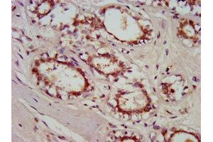 IHC image of ABIN7154777 diluted at 1:800 and staining in paraffin-embedded human breast cancer performed on a Leica BondTM system. (GBP4 antibody  (AA 494-603))