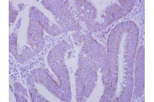IHC-P Image Immunohistochemical analysis of paraffin-embedded human colon carcinoma, using Integrin alpha V, antibody at 1:250 dilution. (CD51 antibody  (C-Term))