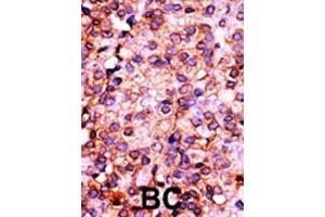 Formalin-fixed and paraffin-embedded human cancer tissue reacted with the primary antibody, which was peroxidase-conjugated to the secondary antibody, followed by AEC staining. (PANK3 antibody  (N-Term))
