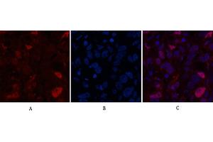Immunofluorescence analysis of human breast cancer tissue. (Caspase 7 antibody  (AA 160-240))