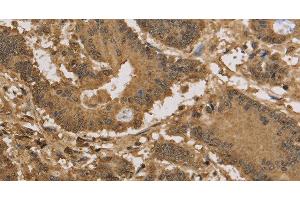 Immunohistochemistry of paraffin-embedded Human colon cancer tissue using KDM5B Polyclonal Antibody at dilution 1:40 (KDM5B antibody)