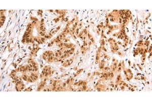 Immunohistochemistry of paraffin-embedded Human colon cancer tissue using TAX1BP1 Polyclonal Antibody at dilution 1:60 (TAX1BP1 antibody)