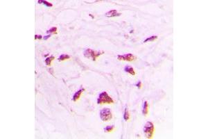 Immunohistochemical analysis of STK17B staining in human lung cancer formalin fixed paraffin embedded tissue section. (DRAK2 antibody  (Center))
