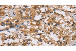 Immunohistochemistry of paraffin-embedded Human thyroid cancer using IL19 Polyclonal Antibody at dilution of 1:40 (IL-19 antibody)