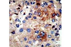 IHC analysis of FFPE human hepatocarcinoma stained with HDAC9 antibody (HDAC9 antibody  (AA 2-32))
