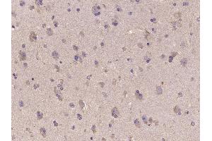 Paraformaldehyde-fixed, paraffin embedded Human brain glioma Antigen retrieval by boiling in sodium citrate buffer (pH6. (IDH1 antibody  (AA 70-115))