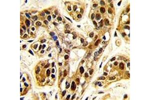 IHC analysis of FFPE human breast carcinoma tissue stained with PRMT1 antibody (PRMT1 antibody  (AA 317-346))