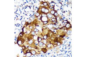 Immunohistochemistry of paraffin-embedded Human breast cancer using WIF1 Rabbit pAb (ABIN6128926, ABIN6150217, ABIN6150219 and ABIN6216799) at dilution of 1:100 (40x lens). (WIF1 antibody  (AA 29-220))