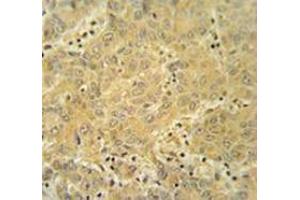 Immunohistochemistry analysis in human hepatocarcinoma tissue (Formalin-fixed, Paraffin-embedded) using CYP2A7  Antibody , followed by peroxidase conjugation of the secondary antibody and DAB staining.
