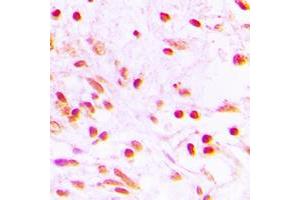 Immunohistochemical analysis of FOSL1 staining in human lung cancer formalin fixed paraffin embedded tissue section. (FOSL1 antibody  (Center))
