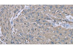 Immunohistochemistry of paraffin-embedded Human esophagus cancer using EZR Polyclonal Antibody at dilution of 1:30 (Ezrin antibody)