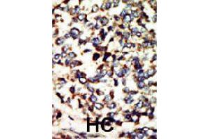 Formalin-fixed and paraffin-embedded human hepatocellular carcinoma tissue reacted with NEK7 polyclonal antibody  , which was peroxidase-conjugated to the secondary antibody, followed by DAB staining. (NEK7 antibody  (N-Term))