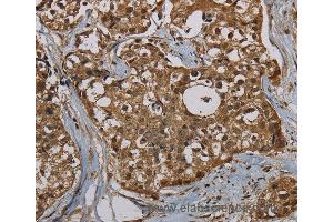 Immunohistochemistry of Human breast cancer using PNN Polyclonal Antibody at dilution of 1:50 (PNN antibody)