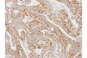 IHC-P Image Immunohistochemical analysis of paraffin-embedded N87 xenograft, using AP2M1, antibody at 1:100 dilution. (AP2M1 antibody  (Center))