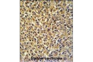 CRIP1 Antibody (C-term) (ABIN650905 and ABIN2839990) IHC analysis in formalin fixed and paraffin embedded bladder carcinoma followed by peroxidase conjugation of the secondary antibody and DAB staining. (CRIP1 antibody  (C-Term))