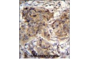 TTC9C Antibody (N-term) (ABIN655122 and ABIN2844752) immunohistochemistry analysis in formalin fixed and paraffin embedded human breast carcinoma followed by peroxidase conjugation of the secondary antibody and DAB staining. (TTC9C antibody  (N-Term))