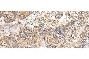 Immunohistochemistry of paraffin-embedded Human gastric cancer tissue using BCHE Polyclonal Antibody at dilution of 1:40(x200) (Butyrylcholinesterase antibody)