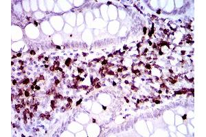Immunohistochemical analysis of paraffin-embedded endometrial cancer tissues using CD7 mouse mAb with DAB staining. (CD7 antibody  (AA 72-175))