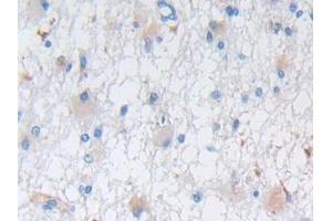 DAB staining on IHC-P; Samples: Human Glioma Tissue (Nestin antibody  (AA 178-399))